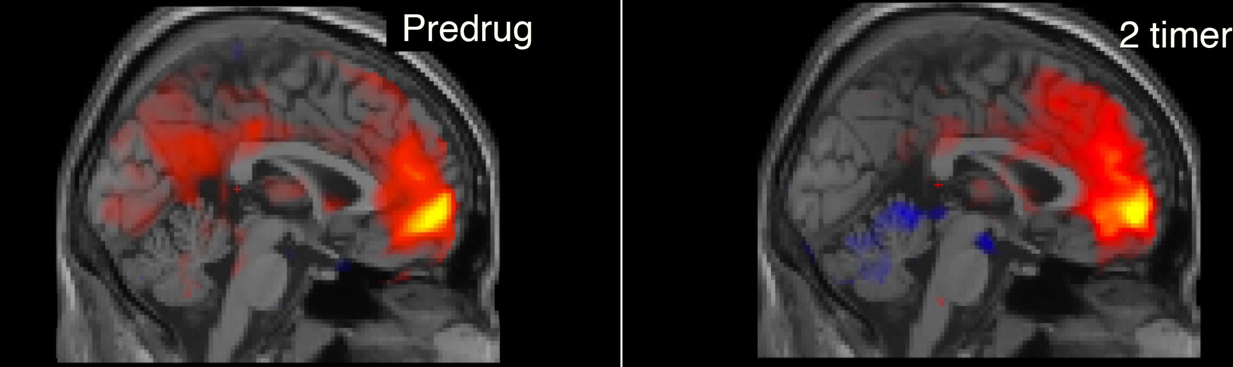 Tv.: fMRI-billedet viser funktionel konnektivitet mellem den mediale præfrontale cortex (MPFC) og resten af hjernen før indgift af psilocybin. Den røde farve i den posteriore cingulate cortex (PCC), viser positiv funktionel konnektivitet med MPFC. Th.: Funktionel konnektivitet for samme forsøgsperson to timer efter 18 mg psilocybin. Fraværet af rød farve i PCC viser markant nedsat funktionel konnektivitet med MPFC. MPFC og PCC er kernestrukturer i default-mode netværk, der er relateret til bla jegoplevelse.